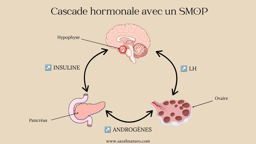 Infographie de la cascade hormonale dans le SMOP/SOPK : flèches à double sens entre hypophyse (LH), pancréas (insuline) et ovaires (androgènes) montrant le cercle vicieux hormonal