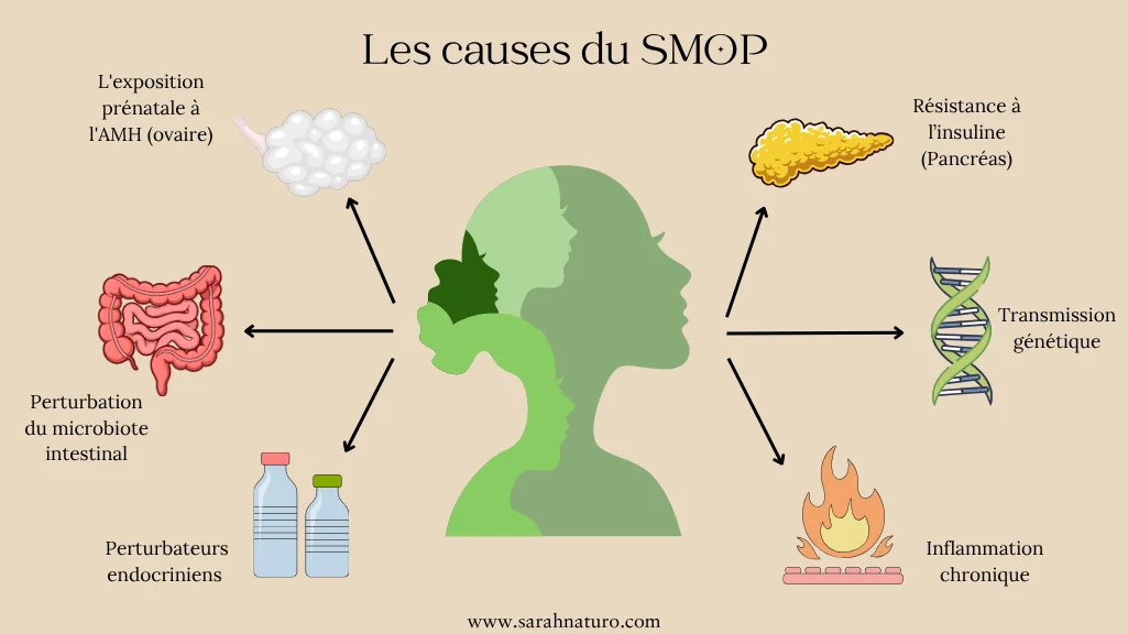 Infographie des causes du SMOP/SOPK : génétique, exposition prénatale à l'AMH, perturbateurs endocriniens, résistance à l'insuline, inflammation chronique et dysbiose du microbiote reliés à un profil féminin