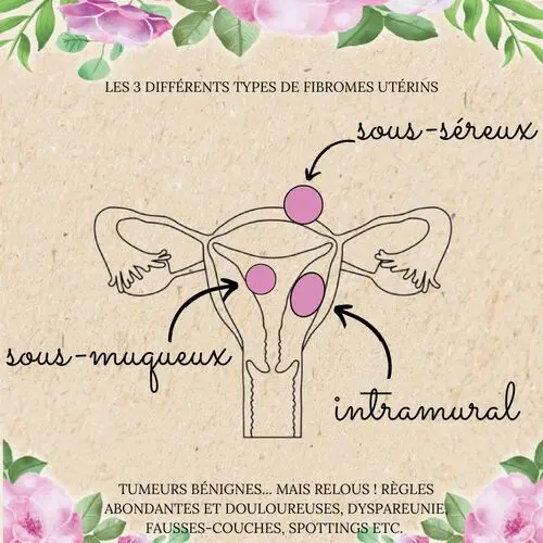 Les 3 différents types de fibromes utérins-min Les 3 différents types de fibromes utérins-min
